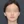 two-jaw surgery (bimaxillary orthognathic surgery) — after (90days) · ReFace Dental Hospital