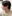 頬骨縮小術（全体／頬骨体部＋頬骨弓の骨切り） — ハイエンド美容外科クリニック