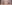 buried suture (non-incisional) double eyelid surgery — Hershey Plastic Surgery Clinic