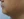 Surfect Lifting (4MHz monopolar RF lifting) — before (7days) · Le Shine Clinic