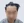 Scalp hair transplant — before (2days) · Okgeon Hairline Clinic