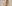 Double chin liposuction (submental liposuction) — Uri Plastic Surgery Clinic