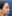 Double chin liposuction (submental liposuction) — Jewelry Plastic Surgery Clinic