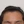 Forehead reduction (hairline lowering surgery) — before (14days) · Ria Plastic Surgery Clinic