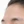 PRP skin rejuvenation (platelet-rich plasma therapy) — before · U&Me Clinic