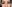 Lower Eyelid Fat Repositioning (transconjunctival) — Uri Plastic Surgery Clinic