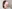 団子鼻修正（鼻尖縮小術） — アーバン美容外科クリニック