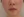 Botox for nasolabial folds — after (10days) · VS Line Clinic - Incheon Guwol Branch