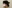 耳たぶヒアルロン酸注入（福耳形成） — ロリポップ美容外科クリニック