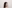 Hairline hair transplant (hairline lowering by grafting) — MoPro Clinic
