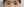 lower blepharoplasty (under-eye bag removal with fat repositioning) — after (7days) · Custom Plastic Surgery Clinic