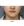 Volnewmer (โวลนิวเมอร์ ยกกระชับด้วย RF) — หลังทำ (30วัน) · คลินิกศัลยกรรมตกแต่งนาบี