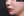 ศัลยกรรมยกริมฝีปากบน (Lip Lift) — หลังทำ (1วัน) · คลินิกเวอรีกูด