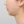 Platysma plication (corset platysmaplasty for double chin/jawline) — before (7days) · AB Plastic Surgery & Skin Clinic