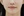 Paranasal (nasal base) augmentation with implant — after (30days) · Apgujeong Lee & Star Clinic