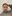 Revision facial contouring surgery (secondary facial bone surgery) — WHY Oral and Maxillofacial Surgery & Dental Clinic