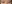 裏ハムラ法（経結膜的眼窩脂肪移動術） — ハッシュ美容外科クリニック