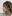 Nasal Tip Plasty with Autologous Cartilage — Uri Plastic Surgery Clinic