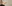 Double chin liposuction (submental liposuction) — Uri Plastic Surgery Clinic
