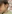 Salivary gland Botox (parotid gland Botox) — Piaf Clinic