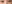 裏ハムラ法（経結膜的眼窩脂肪移動術） — ファクト美容外科クリニック