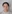 団子鼻修正（鼻尖縮小術） — セギム美容外科クリニック