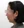 ฉีดสลายไขมันหน้า (เมโสแฟตแก้ม) — ก่อนทำ · ศูนย์ศัลยกรรม Zero - สาขาชินซา