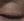 acne scar subcision / regenerative needling — after (50days) · Rodam Korean Medicine Clinic - Gangnam Branch