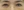 lower blepharoplasty (under-eye bag removal with fat repositioning) — after (7days) · Seoul During Clinic