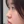 ผ่าตัดเอาสิ่งแปลกปลอมออกจากจมูก (เอาซิลิโคนจมูกออก) — ก่อนทำ (14วัน) · ไฮบอม ศัลยกรรมพลาสติก