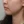 TuneLiner (non-invasive ultrasound fat reduction & contouring) — before (28days) · J.Fill Clinic - Gangnam Branch