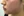 Belotero Revive (HA + glycerol skinbooster) — before (30days) · AB Plastic Surgery & Skin Clinic