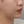 TuneLiner (non-invasive ultrasound fat reduction & contouring) — before (28days) · J.Fill Clinic - Gangnam Branch