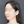 two-jaw surgery (bimaxillary orthognathic surgery) — after (40days) · ReFace Dental Hospital