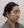 ฉีดสลายไขมันหน้า (เมโสแฟตแก้ม) — ก่อนทำ · ศูนย์ศัลยกรรม Zero - สาขาชินซา