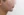 ตัดไขมันกระพุ้งแก้ม — หลังทำ (9วัน) · ไอรูมิ ศัลยกรรมพลาสติก