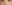 裏ハムラ法（経結膜的眼窩脂肪移動術） — プレジャー美容外科クリニック