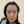 Scalp hair transplant — before (1days) · Okgeon Hairline Clinic