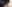 裏ハムラ法（経結膜的眼窩脂肪移動術） — ルホ美容外科クリニック