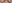 裏ハムラ法（経結膜的眼窩脂肪移動術） — プレジャー美容外科クリニック
