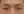 ทำตาสองชั้นแบบเย็บชนิดยึดเกาะตามธรรมชาติ — ก่อนทำ (3วัน) · คลินิกศัลยกรรมตกแต่งคัสตอม