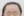 Forehead reduction (hairline lowering surgery) — before (9days) · Goyu Plastic Surgery Clinic