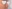 鼻尖形成術（自家軟骨移植） — ハイボム美容外科クリニック