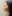団子鼻修正（鼻尖縮小術） — アウラ美容外科クリニック