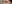 裏ハムラ法（経結膜的眼窩脂肪移動術） — ジャスト美容外科クリニック