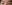 Natural adhesion double eyelid surgery (non-incisional adhesion method) — I-Fit Plastic Surgery Clinic