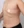 女性化乳房手術（男性の乳腺切除） — 術後 (14日) · 新しい美容外科クリニック