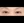 lower blepharoplasty (under-eye bag removal with fat repositioning) — before (7days) · AB Plastic Surgery & Skin Clinic