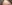 こめかみの脂肪注入 — デビビ美容外科クリニック