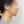 下巴異物取出（下巴假體移除） — 術後 (30天) · Returning醫美診所